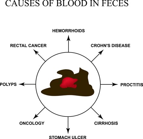 To form black, tarry stools (melena), there must be 150-200 cc of blood and the blood must be in. . Can anabolic steroids cause blood in stool